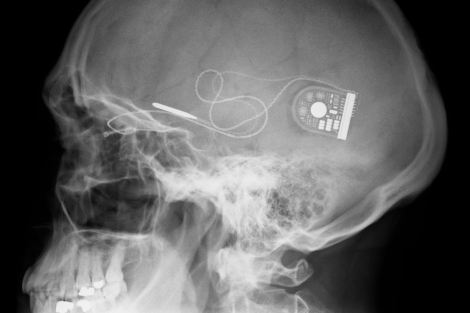 Foto: Radiografía que muestra dónde está colocado el implante.